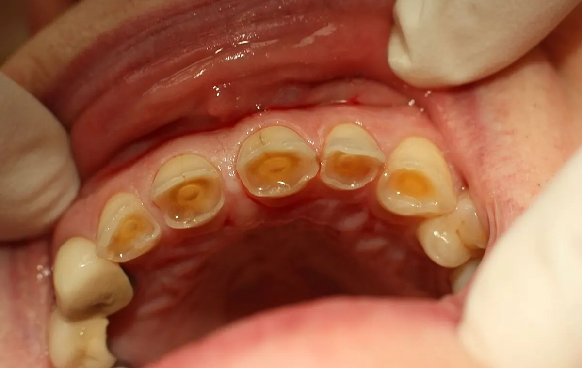 Can You Repair Ground Down Teeth? What You Need to Know