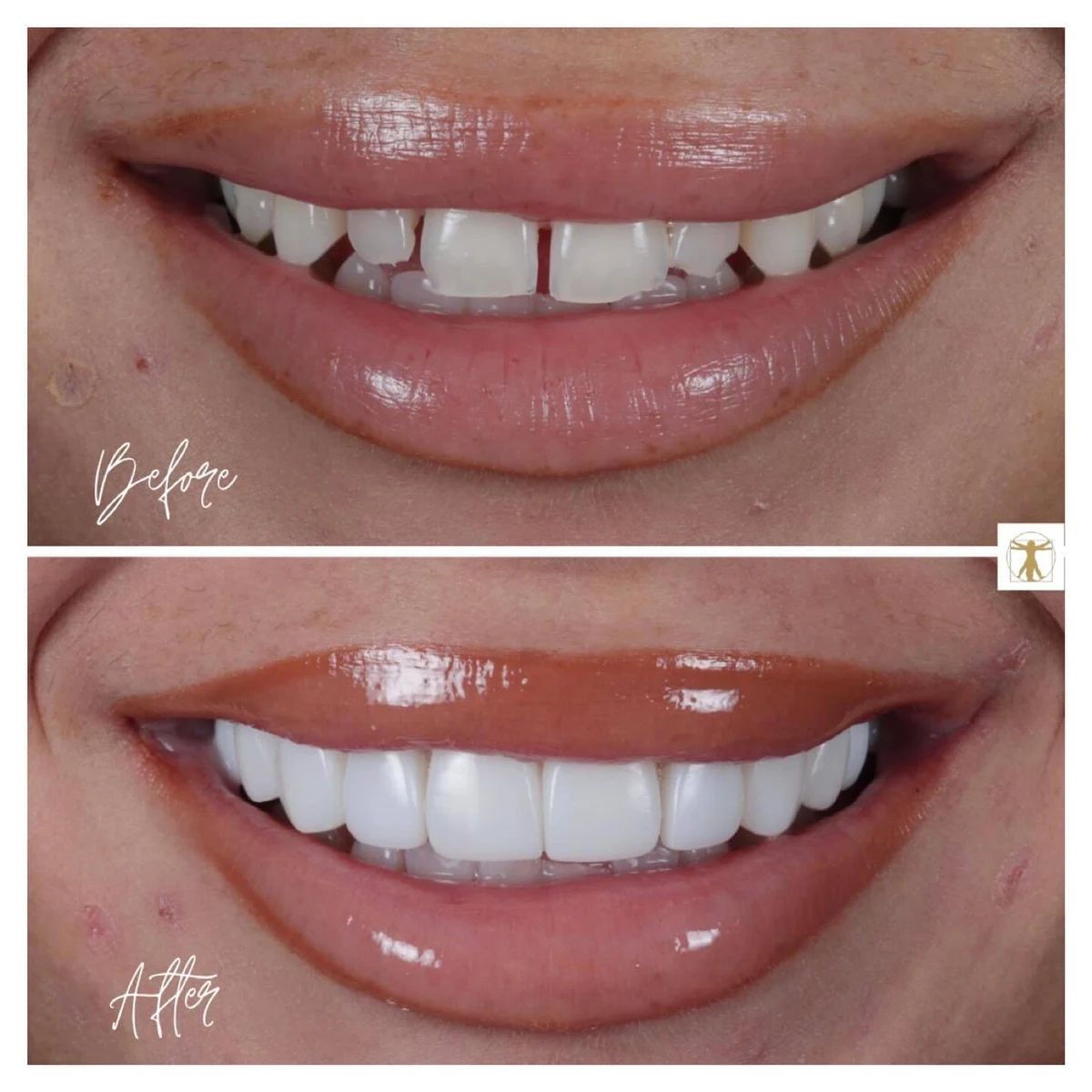 Before-and-after smiles showing composite bonding, with gaps between the upper front teeth before treatment and a more even smile afterwards