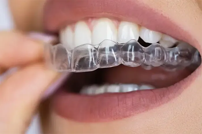 A close up image of the clear aligners that Invisalign provide