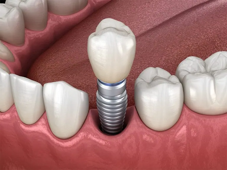 An illustration showing how an implant is placed