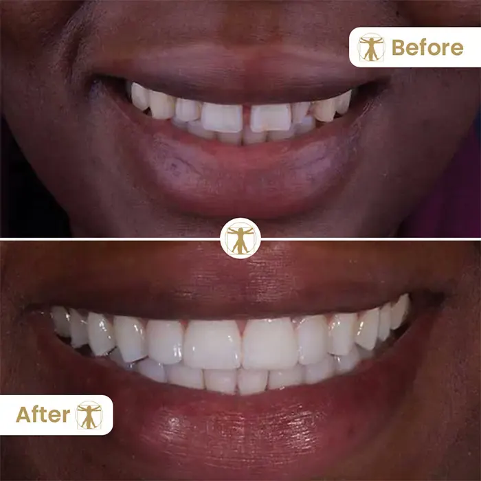 Invisalign Before and After Comparison