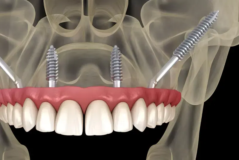 Zygomatic and Pterygoid Implants – Advanced Options for Patients with Severe Bone Loss