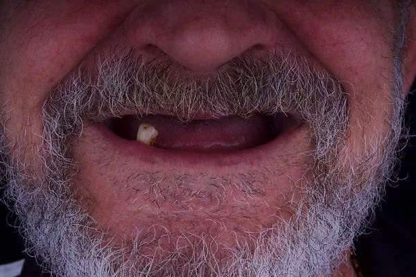 Denture before treatment