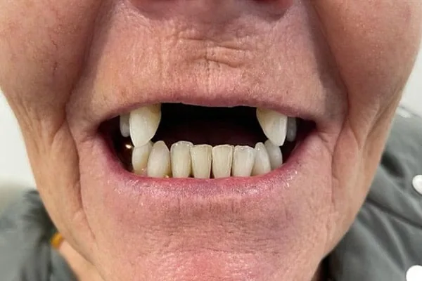 Denture before treatment
