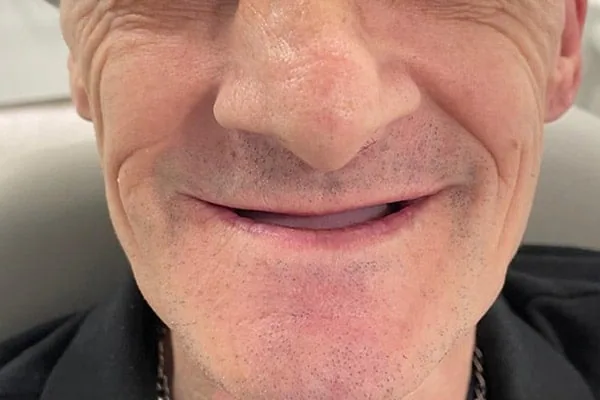 Denture before treatment