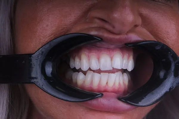 Clear Aligners before treatment