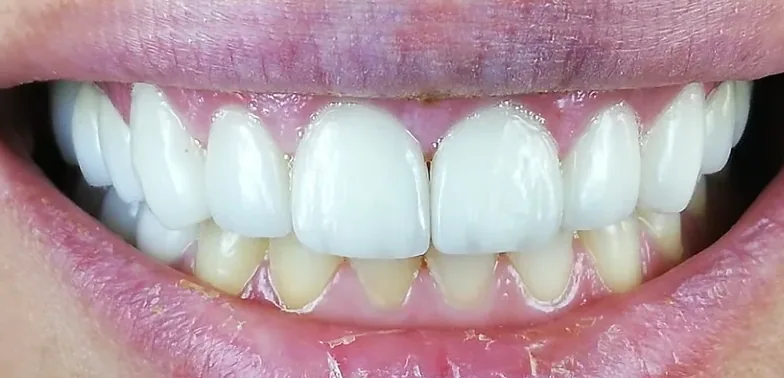 Gum contouring after treatment
