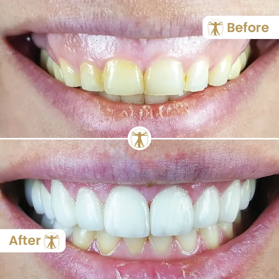 Gum contouring before and after treatment at Vitruvian Dental Studio