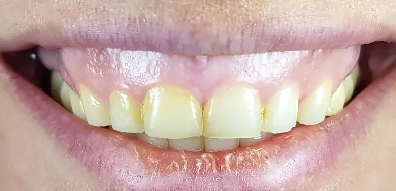 Gum contouring before treatment