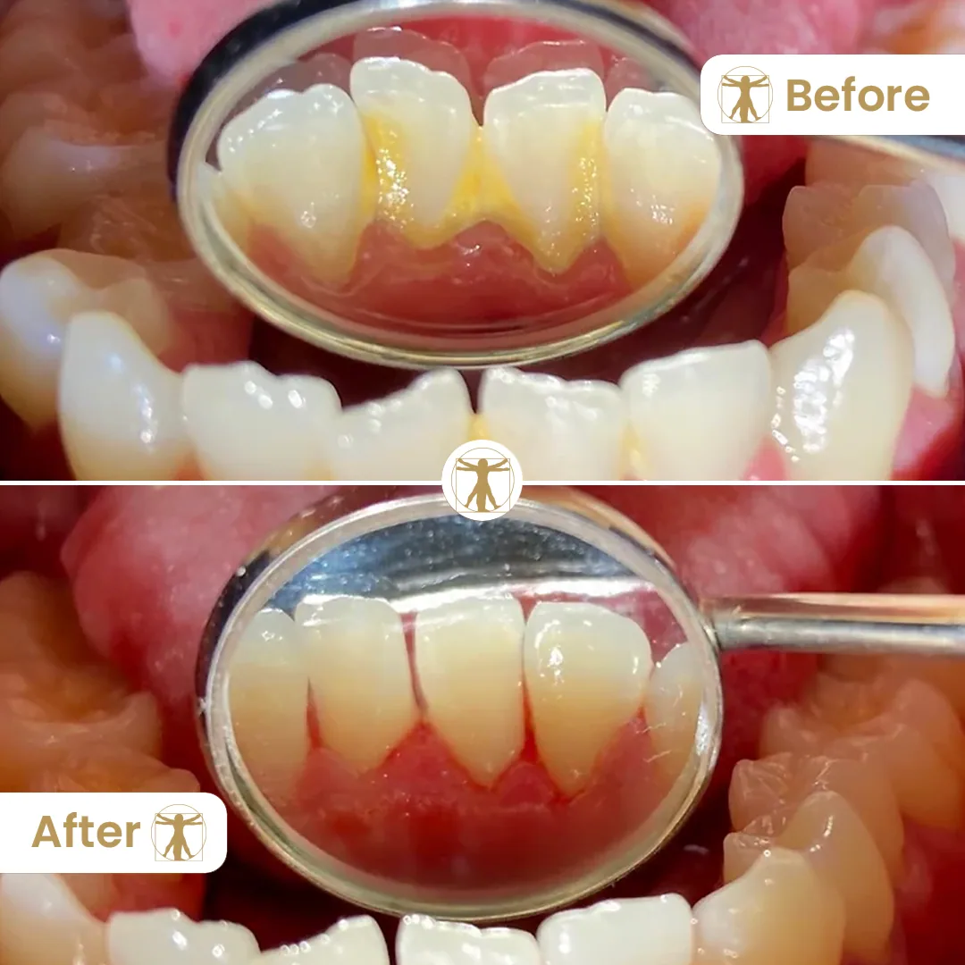Before and after a professional dental hygiene appointment at Vitruvian Dental Studio