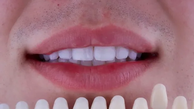 Teeth whitening after treatment