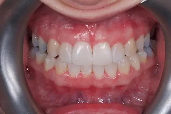 Clear Aligners after treatment