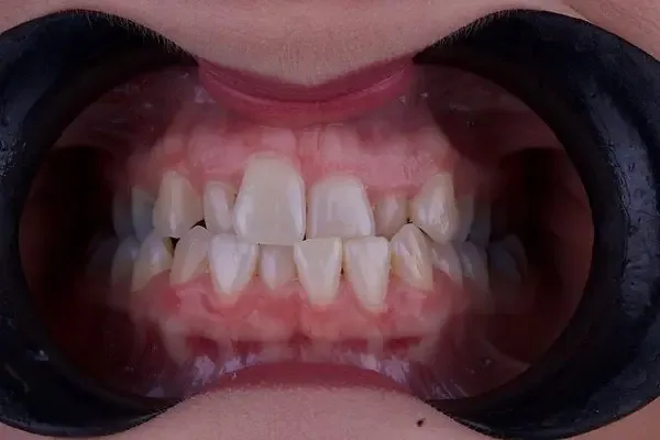 Clear Aligners before treatment