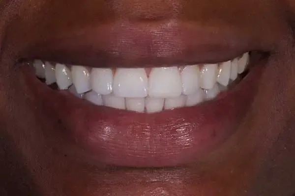 Clear Aligners after treatment