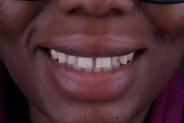 Clear Aligners before treatment