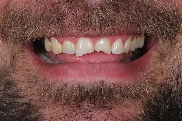 Composite bonding before treatment