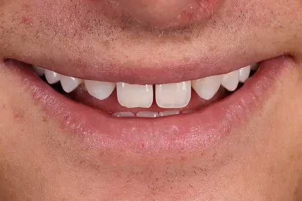 Composite bonding before treatment