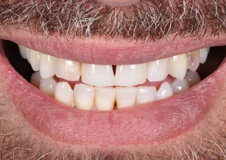 Veneer and crown before treatment