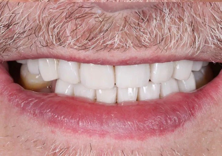Veneer and crown after treatment
