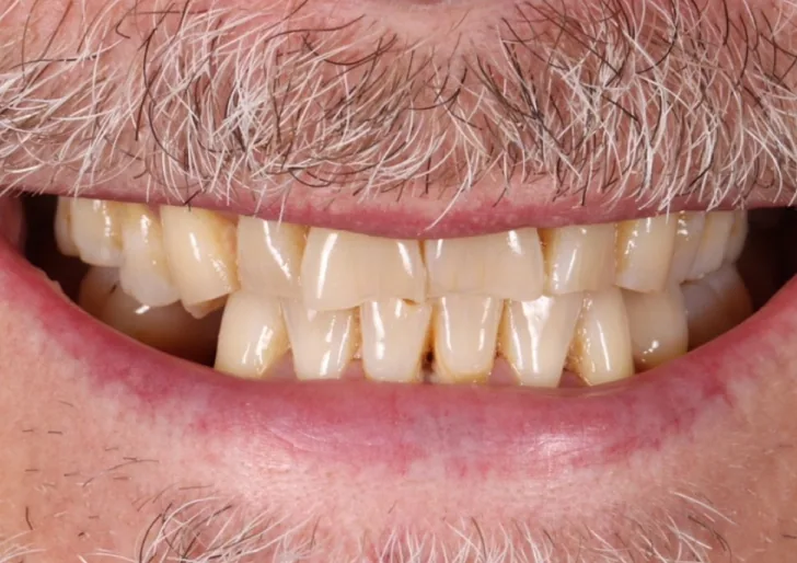 Veneer and crown before treatment