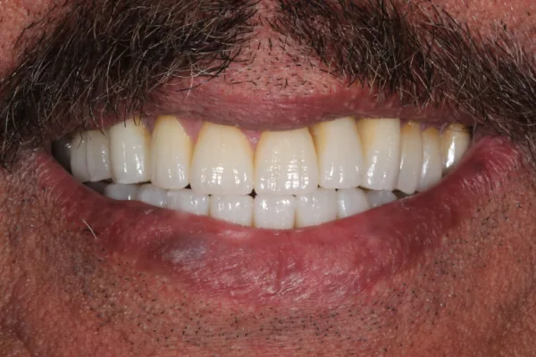 Veneer and crown after treatment