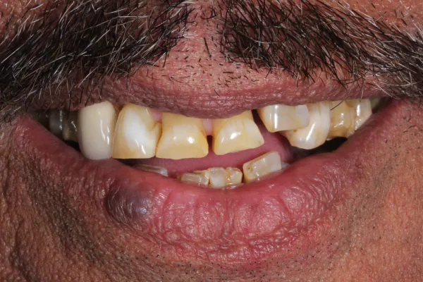 Veneer and crown before treatment