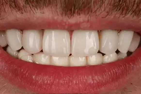 Dental implant after treatment