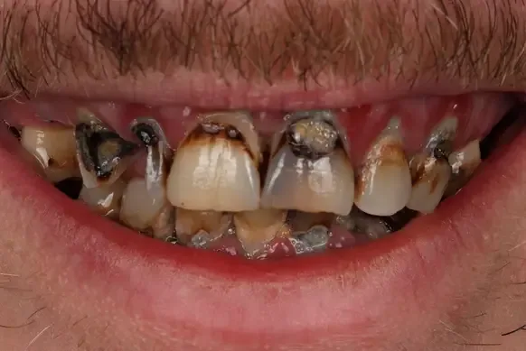 Dental implant before treatment
