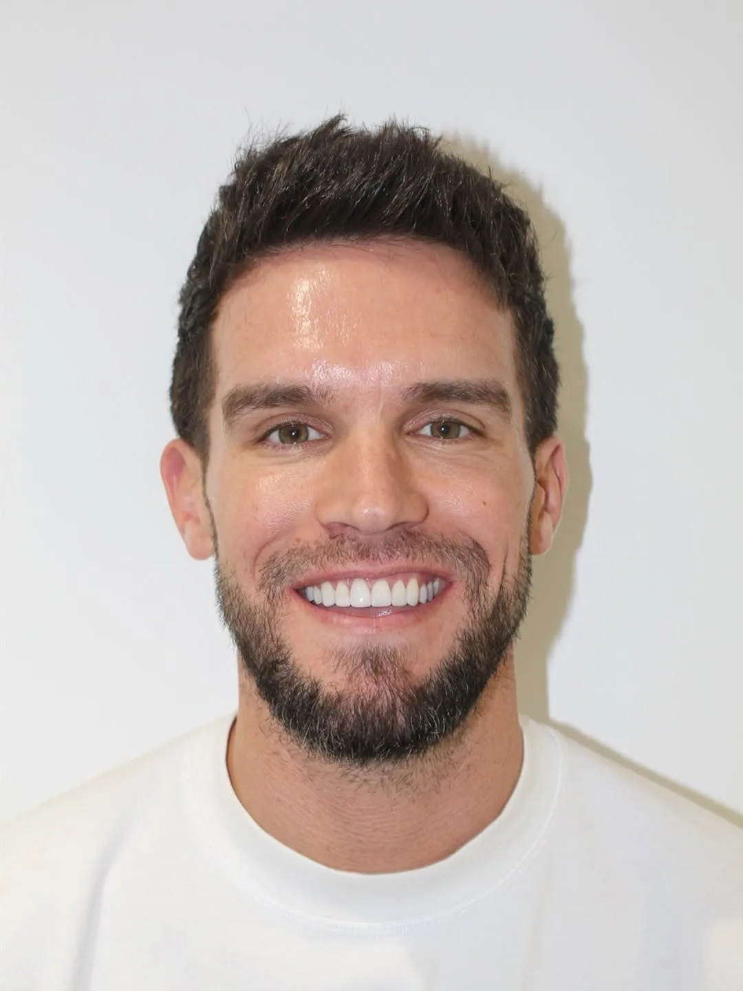 Composite bonding patient portrait after treatment
