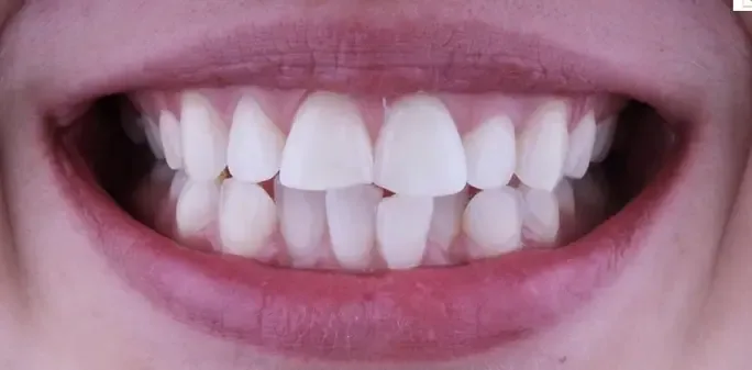 Teeth whitening after treatment