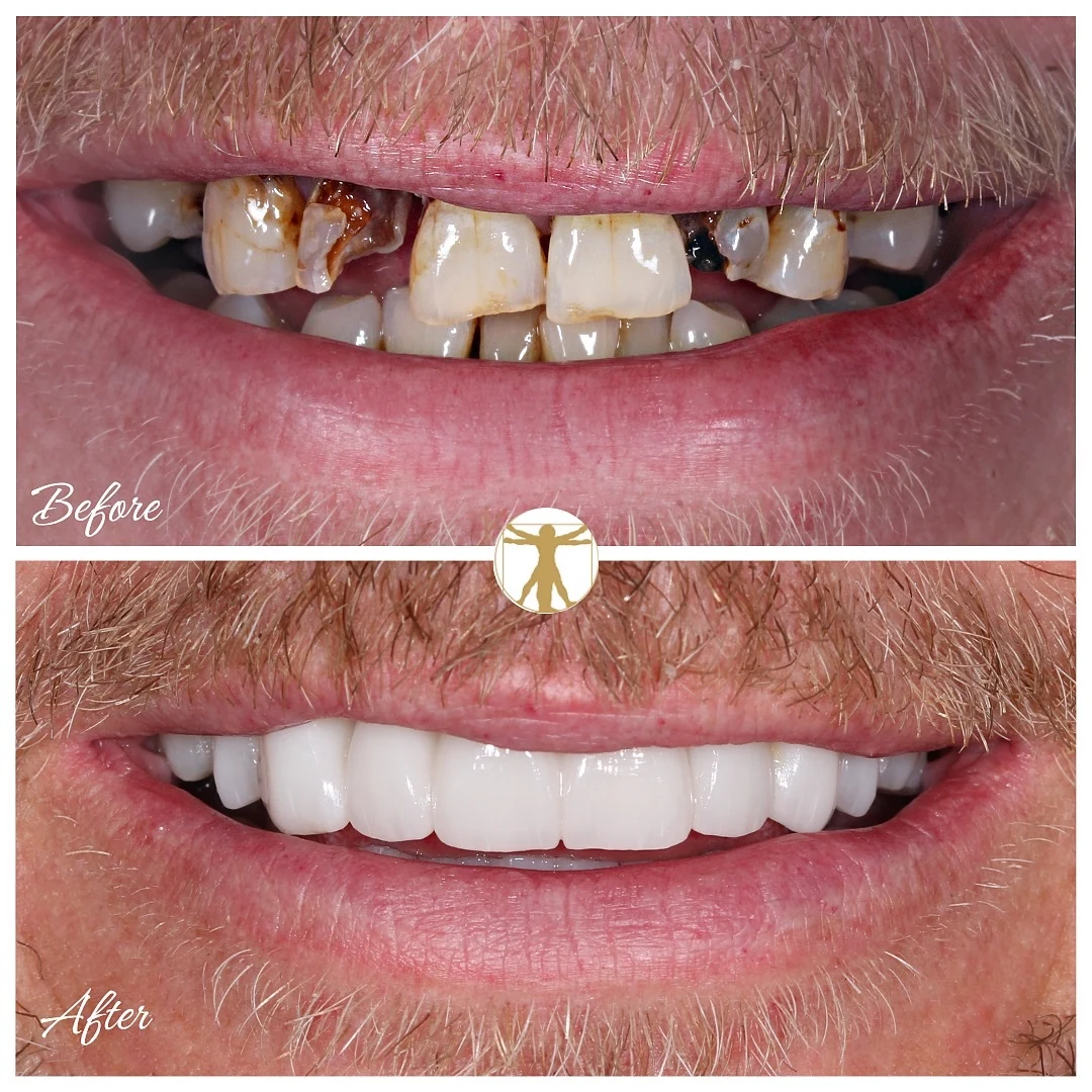 Crowns and veneers before-and-after comparison, with before above and after below