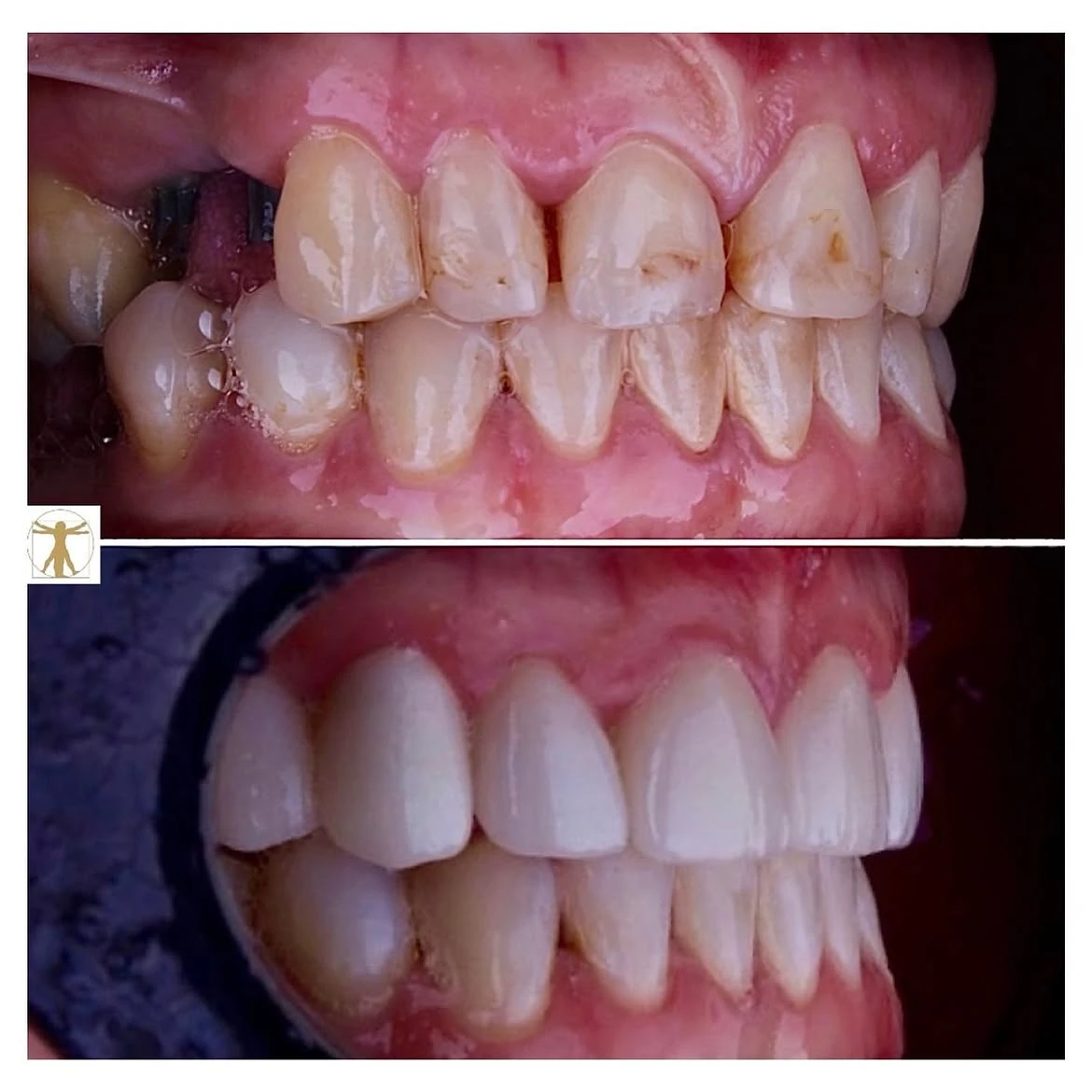 Dental bridge before-and-after comparison, with before above and after below