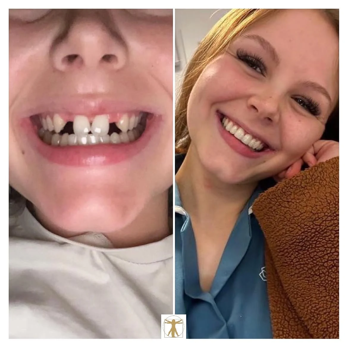 Dental bridge patient comparison with the before image on the left and after image on the right