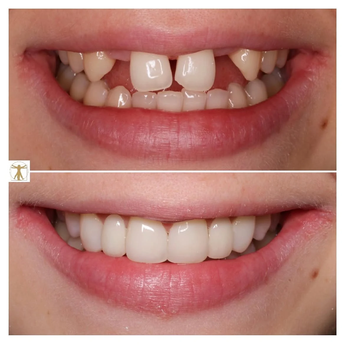 Dental bridge before-and-after smile comparison at Vitruvian Dental Studio