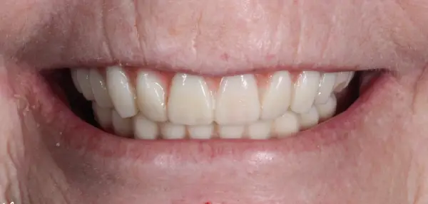 Dental implant case 1 after treatment