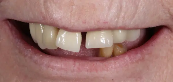 Dental implant case 1 before treatment