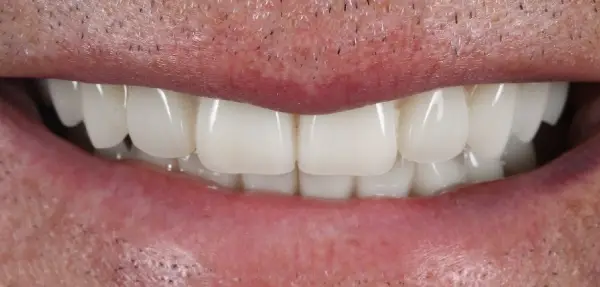 Dental implant case 2 after treatment