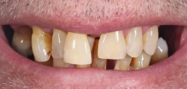 Dental implant case 2 before treatment