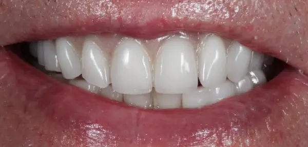 Dental implant case 3 after treatment