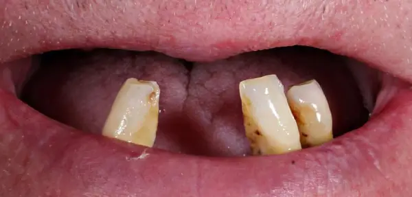 Dental implant case 3 before treatment