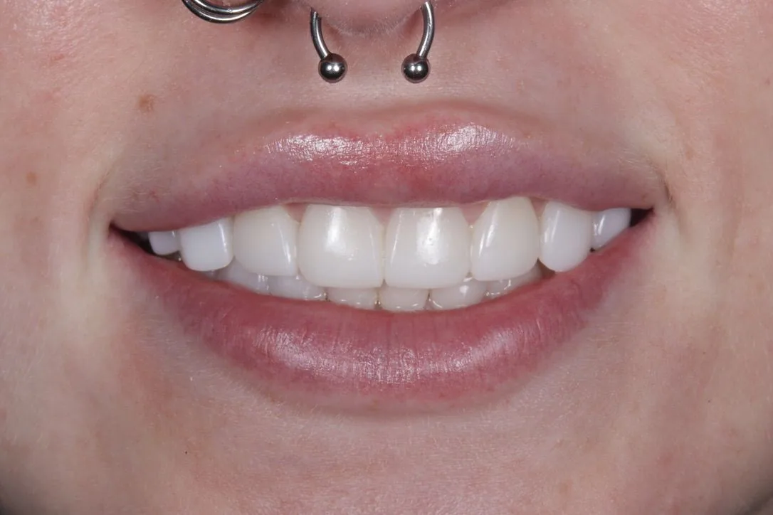 Completed Clear Aligners smile with composite edge bonding