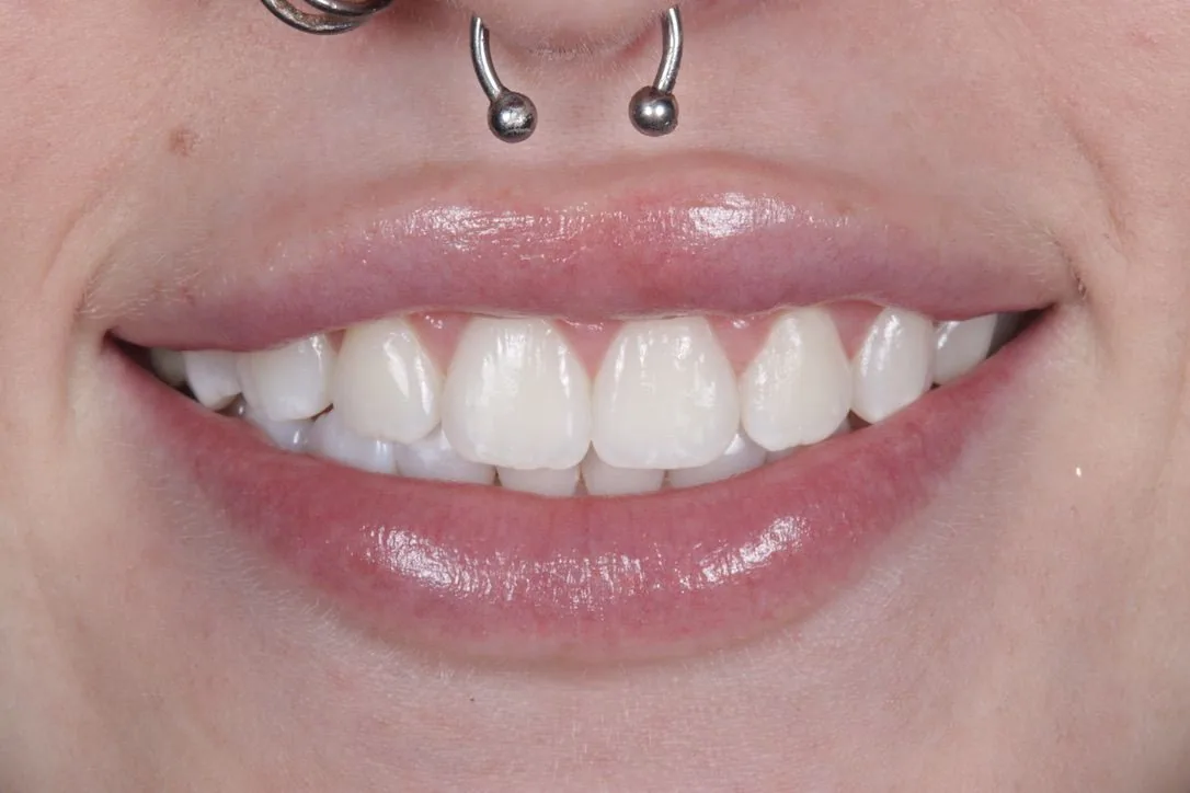Clear Aligners patient after whitening
