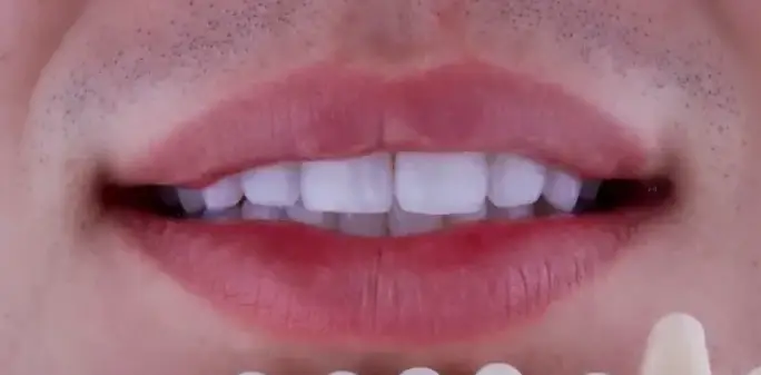 Teeth whitening after treatment