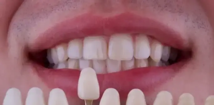 Teeth whitening before treatment