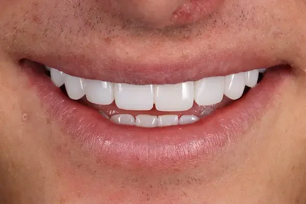 Composite Bonding after treatment, case 1