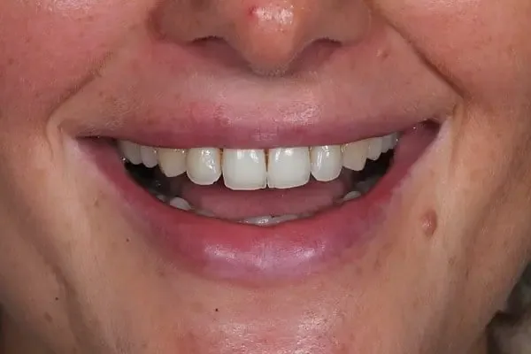 Composite Bonding before treatment, case 2