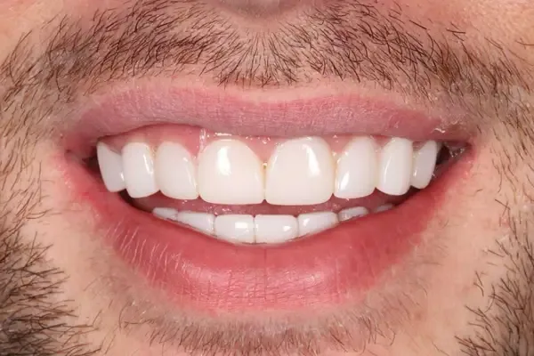 Composite Bonding after treatment, case 3