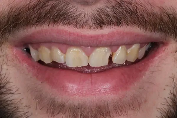 Composite Bonding before treatment, case 3