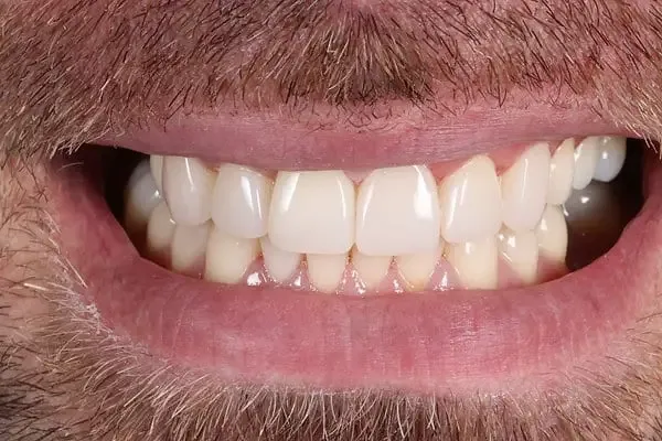 Composite Bonding after treatment, case 4