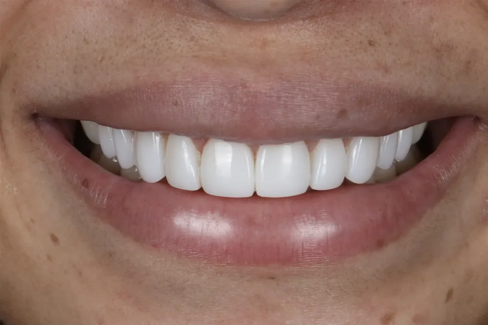 Composite Bonding after treatment, case 5